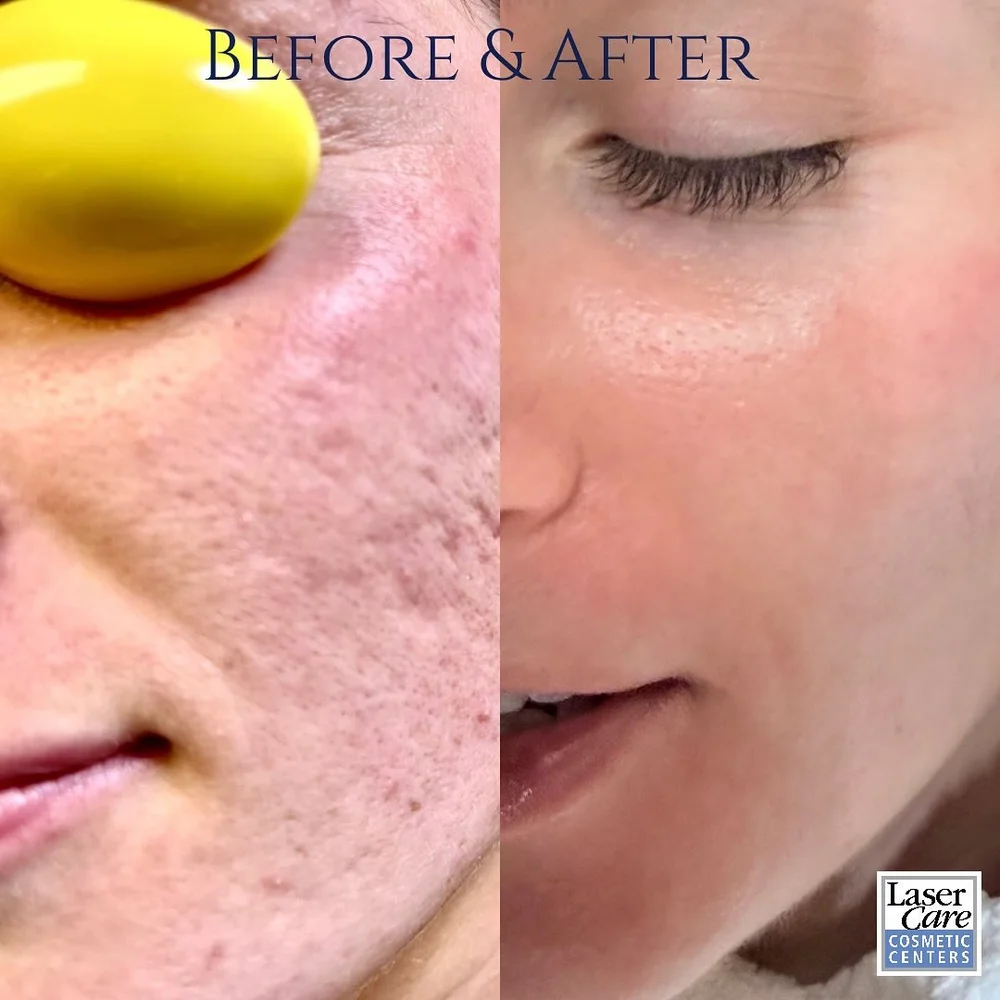 Before and after skin texture treatment