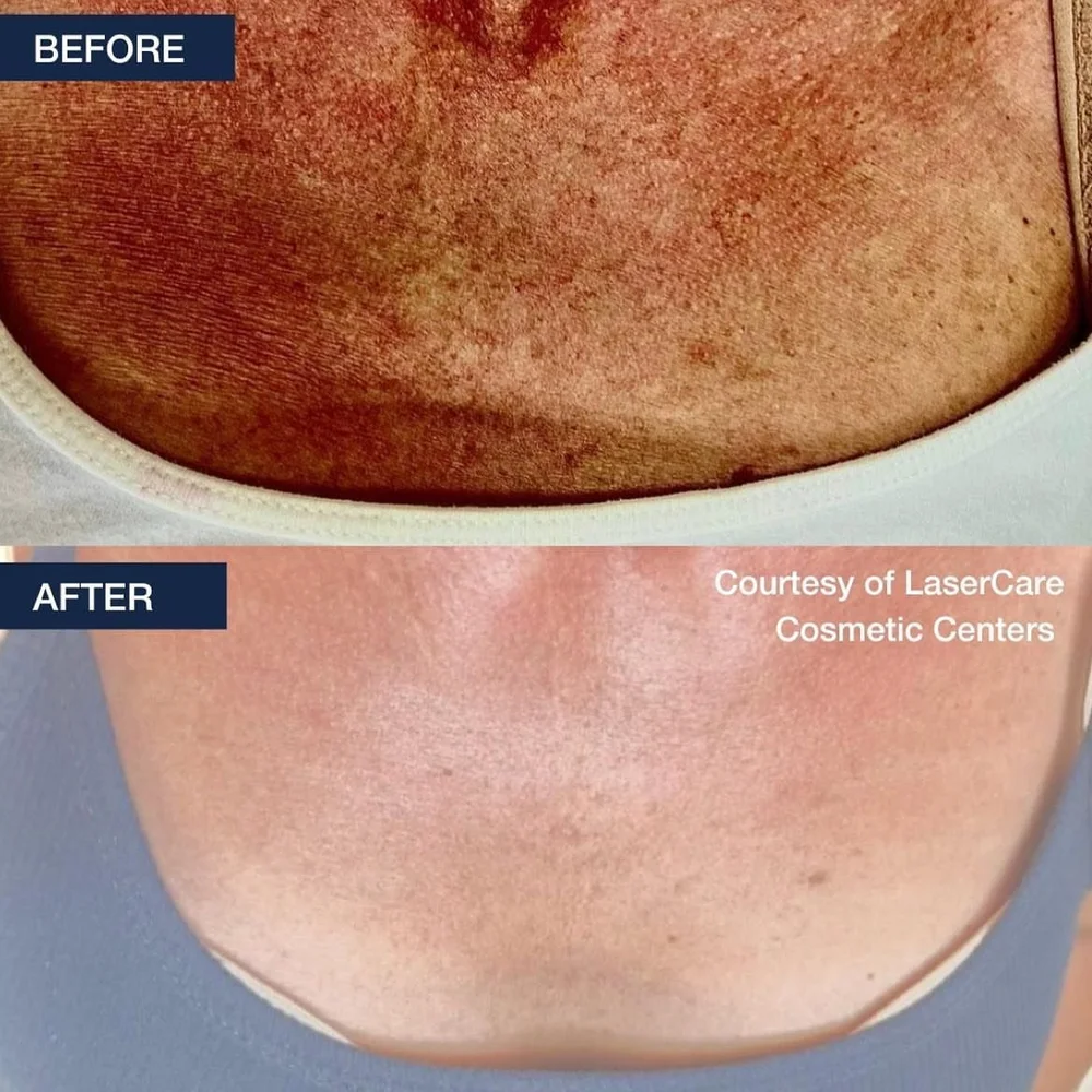 Before and after chest skin tone treatment